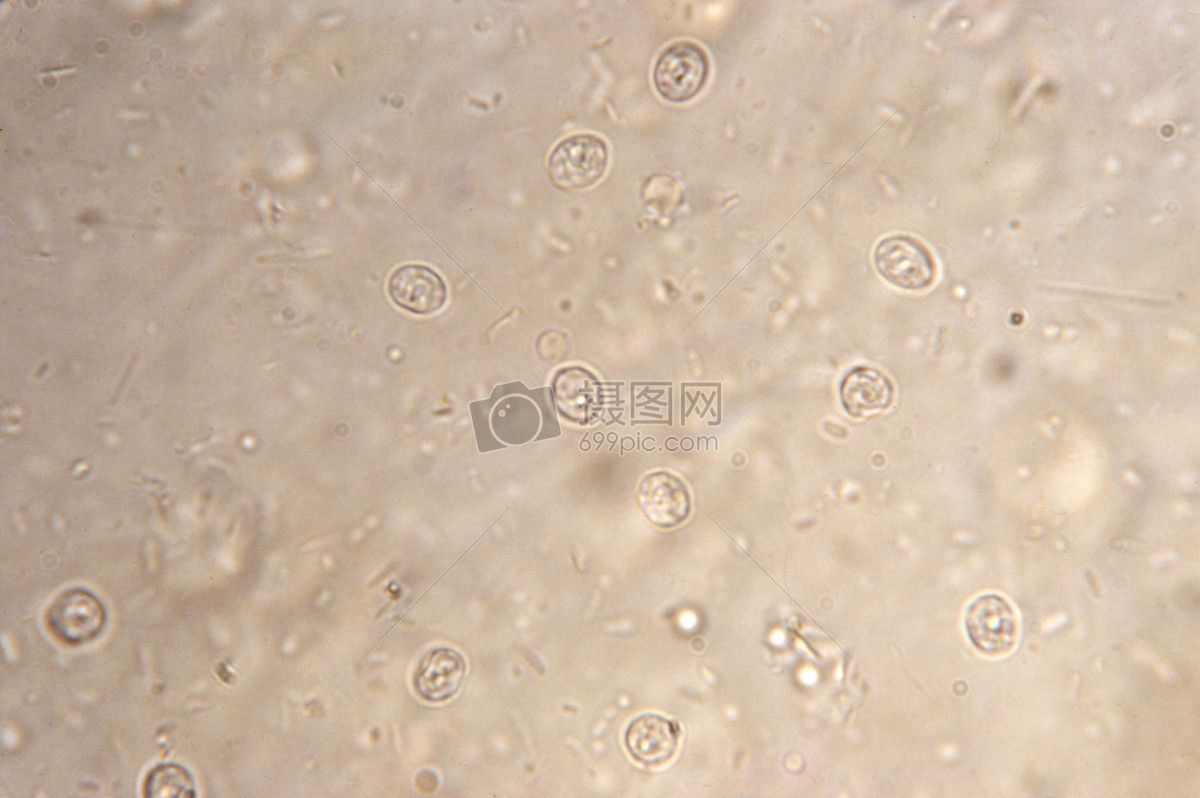 这是一个粪便涂片显微镜揭示了隐孢子虫,因为这病人的隐孢子虫病的