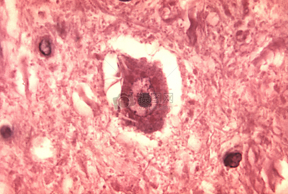 这显微照片描述了使用h&e染色的狂犬病脑炎相关的病理