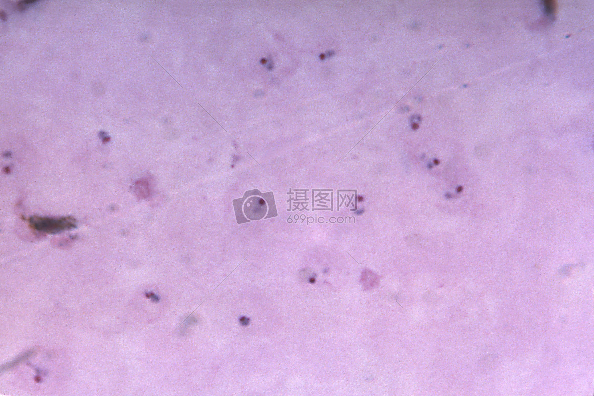 该厚膜显微照片显示了许多间日疟原虫完全和不完全阶段环滋养体,放大