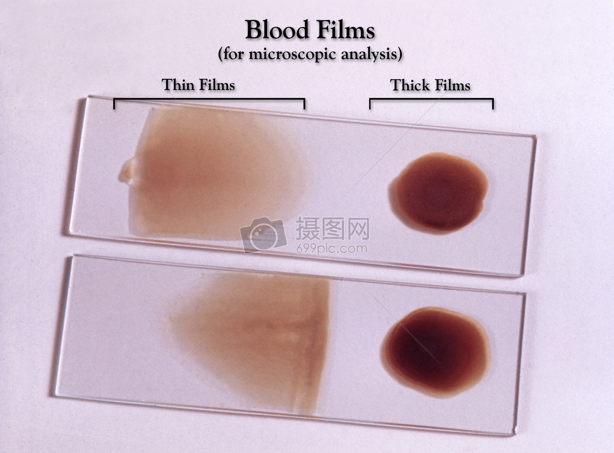 这些制备载玻片提供在显微镜下进行检查厚和薄血涂片的外观的例子.