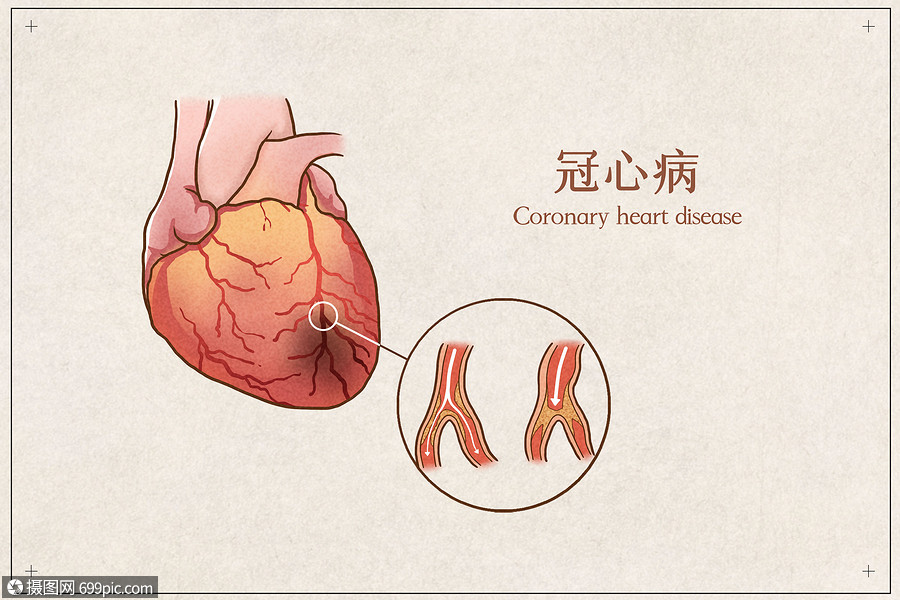 冠心病医疗插画示意图