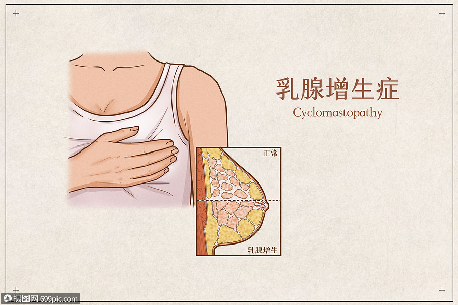 乳腺增生症医疗插画示意图