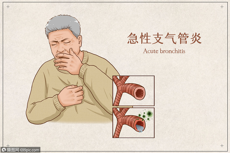 急性支气管炎医疗插画