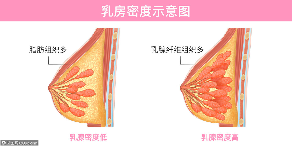 乳腺密度示意图医疗插画