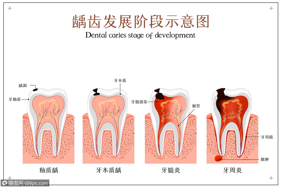 龋齿发展阶段示意图医美牙釉质