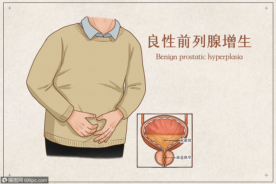 良性前列腺增生医疗插画临床看病
