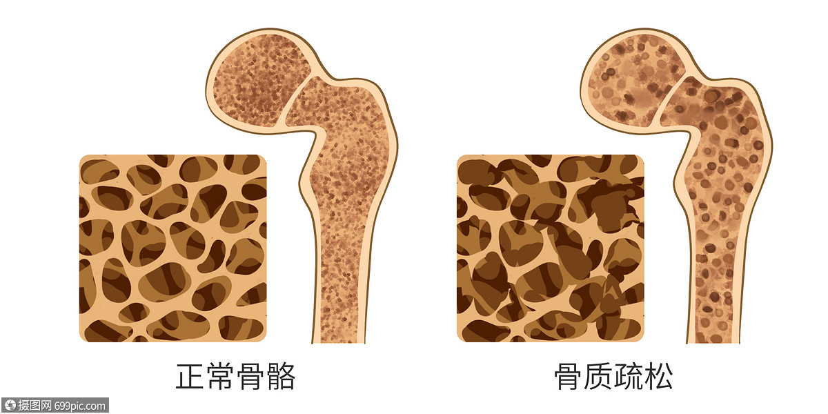 正常骨质和骨质疏松对比医疗插画