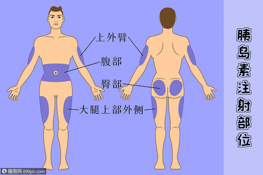 糖尿病患者胰岛素注射部位男性人体
