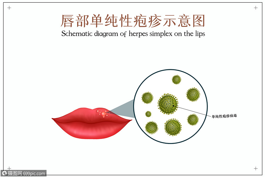 口腔单纯性疱疹口腔医学插图