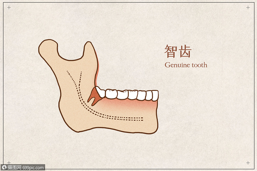 阻生智齿医疗插画示意图
