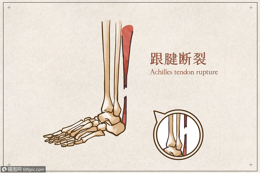 跟腱断裂病例医疗插画
