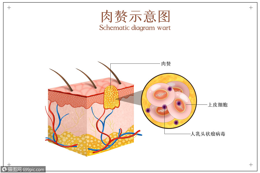 皮膚病變之肉贅示意圖