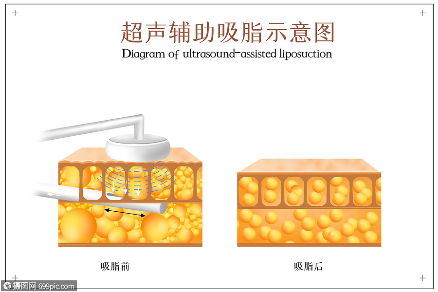 超声波吸脂图片