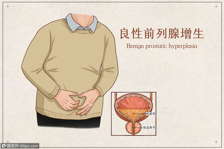 良性前列腺增生醫療插畫臨床看病