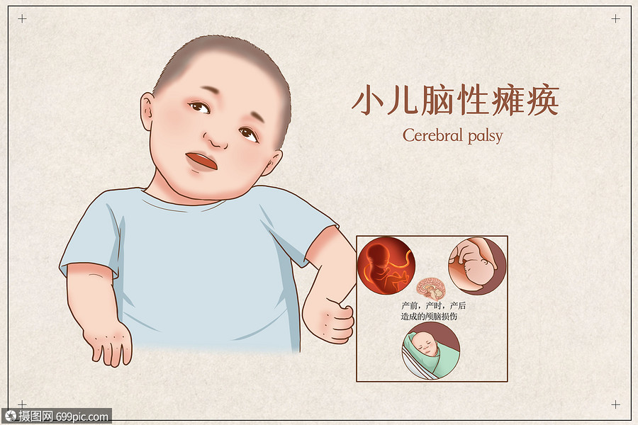 小儿脑性瘫痪医疗插画