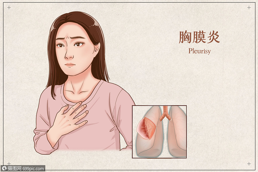 胸膜炎医疗插画